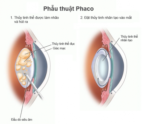 phẫu thuật Phaco