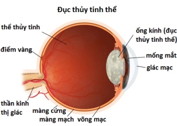 Đục thủy tinh thể là gì?