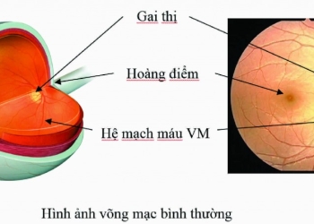 [:vi]Nguyên nhân, dấu hiệu và phương pháp điều trị bong võng mạc[:]