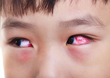 [:vi]Các nguyên nhân và cách điều trị đau mắt đỏ [:en]Các nguyên do và cách điều trị đau mắt đỏ[:]