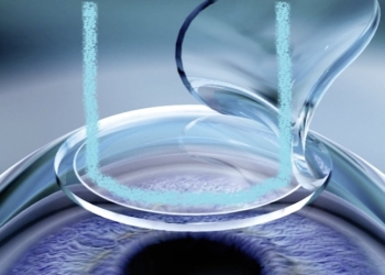 [:vi]Femto-Lasik: Lasik không dao, giải pháp cho người sợ dao kéo[:]