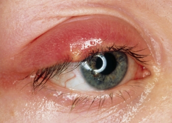 [:vi]Phân biệt chắp và lẹo, nguyên nhân và cách điều trị[:]