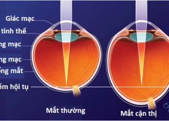 [:vi]Phân loại cận thị[:]