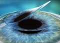 Phau thuat Lasik 01