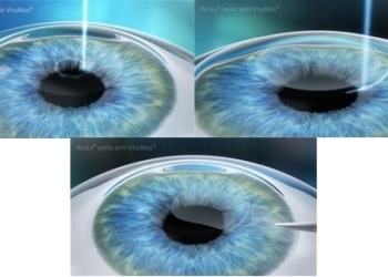 [:vi]Thêm sự lựa chọn cho phẫu thuật khúc xạ ngoài ReLEx SMILE và Femto-Lasik[:]