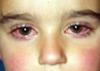 [:vi]Điều cần biết về viêm kết mạc mùa xuân[:]