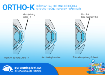 [:vi]Ortho-k: giải pháp hạn chế tăng độ khúc xạ cho các trường hợp chưa phẫu thuật[:]