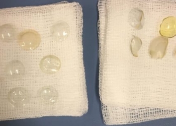 [:vi]Phát hiện 27 chiếc kính áp tròng trong mắt một phụ nữ suốt 35 năm[:]