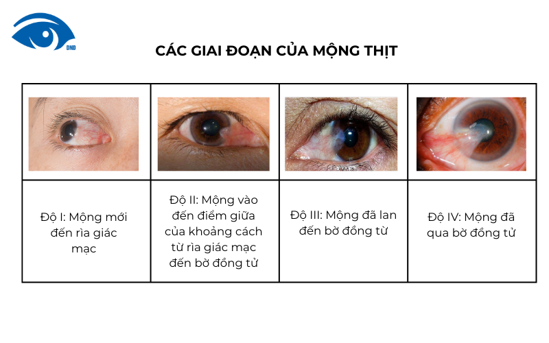 Các giai đoạn của mộng thịt