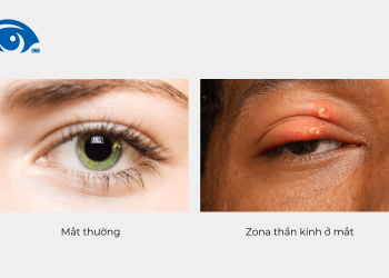 Zona thần kinh ở mắt có lây được không?