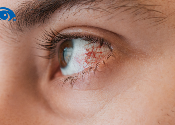 Cần điều trị dị ứng mắt như thế nào cho hiệu quả?