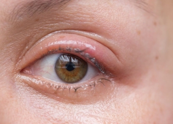 Viêm bờ mi mắt: Nguyên nhân, triệu chứng và cách phòng ngừa