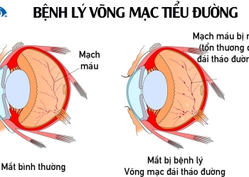 Bệnh lý võng mạc tiểu đường