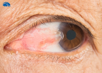 Cách chăm sóc mắt sau khi mổ mộng thịt giúp mau lành, tránh tái phát