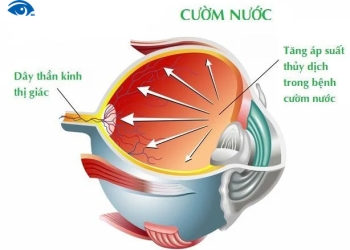 bệnh glaucoma (cườm nước) nguyên nhân và cách điều trị
