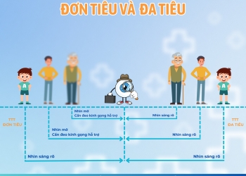 PHÂN BIỆT GIỮA THỦY TINH THỂ ĐA TIÊU VÀ ĐƠN TIÊU: LỰA CHỌN THỦY TINH THỂ NHÂN TẠO PHÙ HỢP