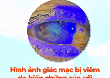 Viêm giác mạc do sởi – Dấu hiệu cảnh báo không nên bỏ qua!