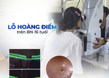 Từ “điểm đen nhỏ” trong mắt đến căn bệnh nguy hiểm