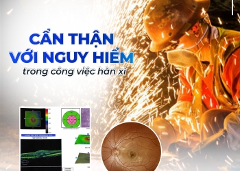 CẢNH BÁO: MỐI HÀN BẮN VÀO MẮT – NGUY CƠ SUY GIẢM THỊ LỰC NGHIÊM TRỌNG