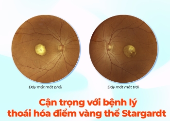 Cẩn trọng với bệnh lý thoái hóa điểm vàng thể Stargardt ở người cao tuổi