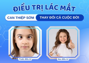 Điều trị lác mắt – Can thiệp sớm, thay đổi cả cuộc đời