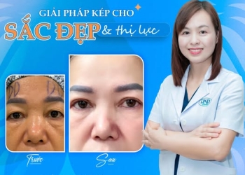 Cắt dư da mí mắt: Giải pháp kép cho sắc đẹp và thị lực