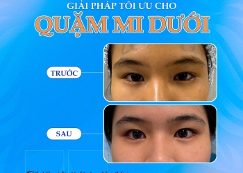 Tạm biệt quặm mi dưới, tự tin khoe đôi mắt khỏe đẹp rạng ngời