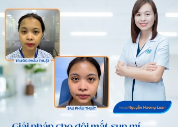 Giải pháp cho đôi mắt sụp mí – Lấy lại ánh nhìn, lấy lại tự tin