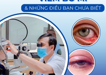 Viêm Bờ Mi: Nguyên Nhân, Triệu Chứng & Cách Phòng Tránh Hiệu Quả