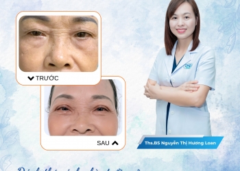 Đánh thức ánh nhìn tuổi xuân – Giải pháp xóa da mí mắt an toàn, tự nhiên