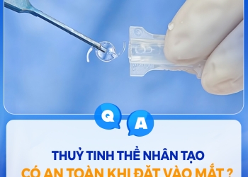 Q&A: Thủy tinh thể nhân tạo có an toàn khi đặt vào mắt?
